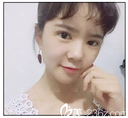 找田躍平做完雙眼皮生活照 找田躍平做完雙眼皮生活照