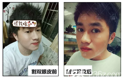 在廣州美萊找田躍平做完雙眼皮對(duì)比圖 在廣州美萊找田躍平做完雙眼皮對(duì)比圖