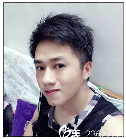 雙眼皮術(shù)后自拍 雙眼皮術(shù)后自拍