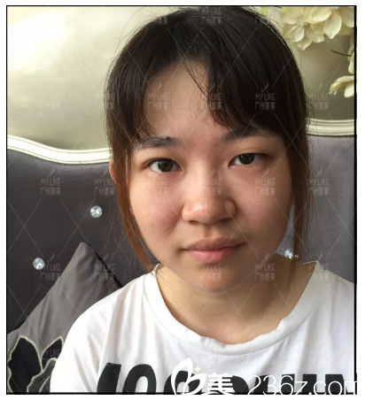 雙眼皮術(shù)前照片 雙眼皮術(shù)前照片