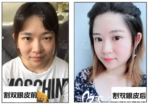 田躍平醫(yī)生割雙眼皮前后對(duì)比圖 田躍平醫(yī)生割雙眼皮前后對(duì)比圖