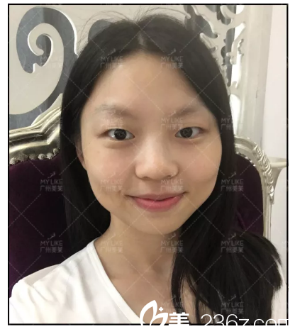 雙眼皮術(shù)前留影 雙眼皮術(shù)前留影