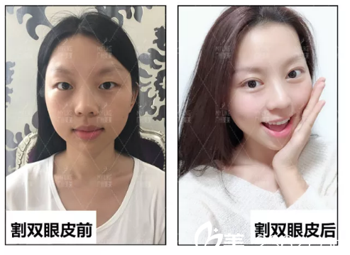 田躍平雙眼皮案例前后對(duì)比 田躍平雙眼皮案例前后對(duì)比