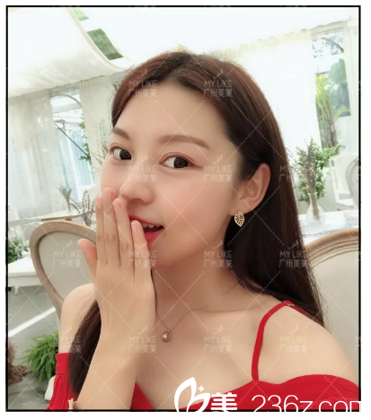 在廣州美萊割完雙眼皮自拍 在廣州美萊割完雙眼皮自拍