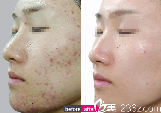 李有得祛痘治療前后效果對比 李有得祛痘治療前后效果對比