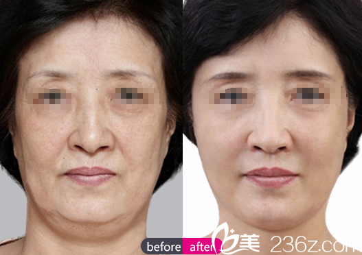 李有得祛皺案例對比圖 李有得祛皺案例對比圖