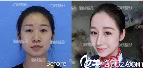 濟(jì)南海峽醫(yī)院假體隆鼻手術(shù)效果
