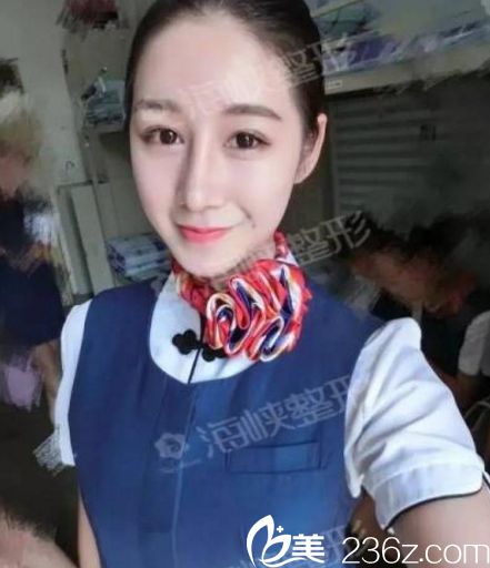濟(jì)南海峽醫(yī)院假體隆鼻手術(shù)一個(gè)月后效果