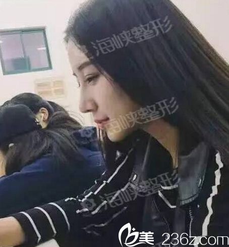 濟(jì)南海峽醫(yī)院假體隆鼻手術(shù)效果怎么樣