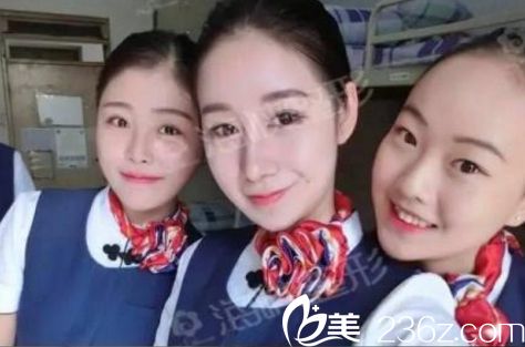 濟(jì)南海峽醫(yī)院假體隆鼻手術(shù)效果兩個(gè)月后效果