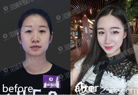 濟(jì)南海峽醫(yī)院假體隆鼻手術(shù)前后對(duì)比圖片