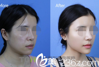 馮輝利整形案例