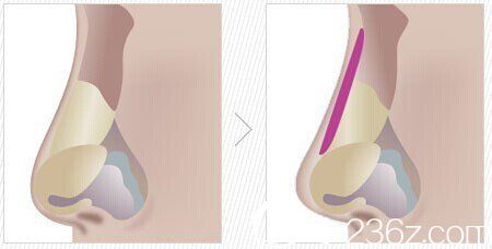 假體隆鼻放置位置