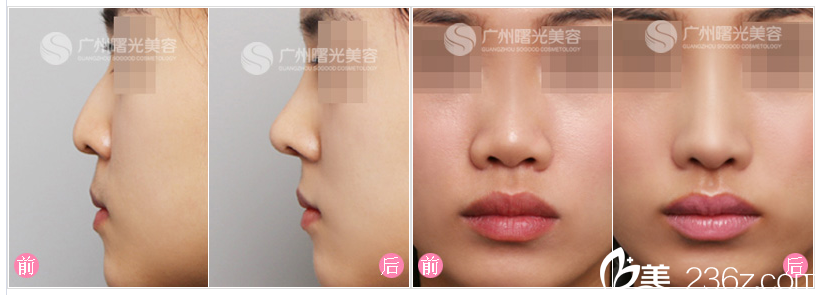 廣州曙光劉杰偉隆鼻案例 廣州曙光劉杰偉隆鼻案例