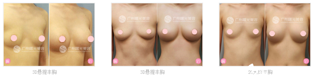 廣州曙光劉杰偉隆胸案例 廣州曙光劉杰偉隆胸案例