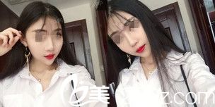 瘦臉17天后效果