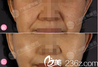  廣州曙光蔣晟中面部拉皮術案例