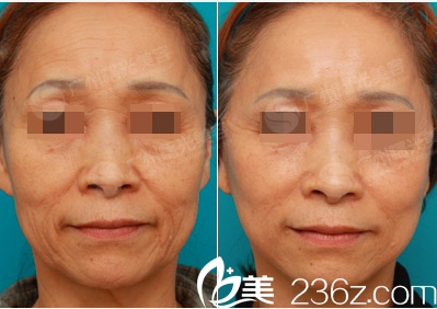  廣州曙光蔣晟面部年輕化案例