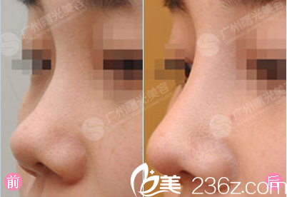  廣州曙光蔣晟肋軟骨隆鼻案例