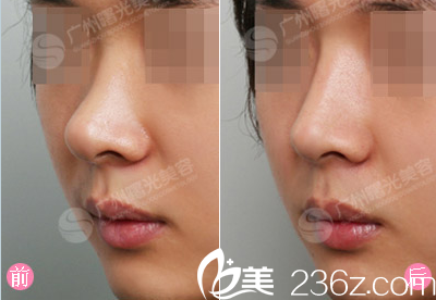 廣州曙光蔣晟肋鼻綜合案例