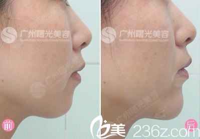 廣州曙光劉永波隆下頦案例對(duì)比圖