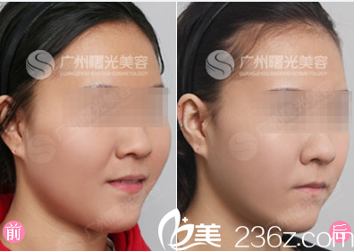 廣州曙光劉永波顴骨整形案例