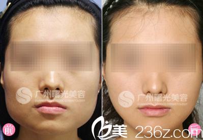 廣州曙光劉永波下頜角整形案例