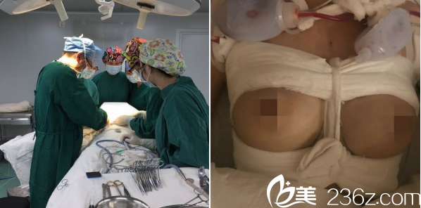 廣州曙光劉杰偉隆胸過程 廣州曙光劉杰偉隆胸過程