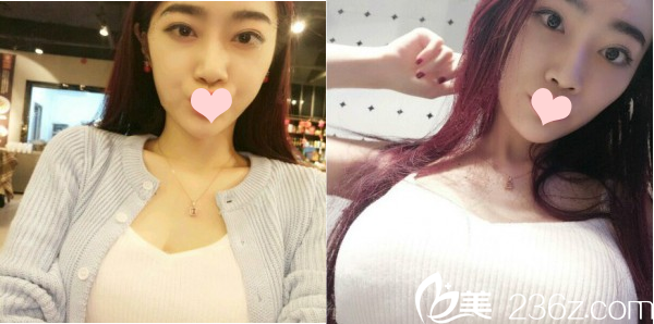 廣州曙光假體隆胸40天自拍 廣州曙光假體隆胸40天自拍