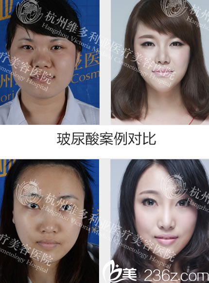 方葉琴醫(yī)生注射玻尿酸案例圖 方葉琴醫(yī)生注射玻尿酸案例圖