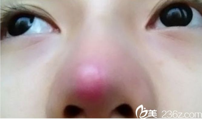 隆鼻硅膠穿出 隆鼻到底是膨體好還是硅膠好