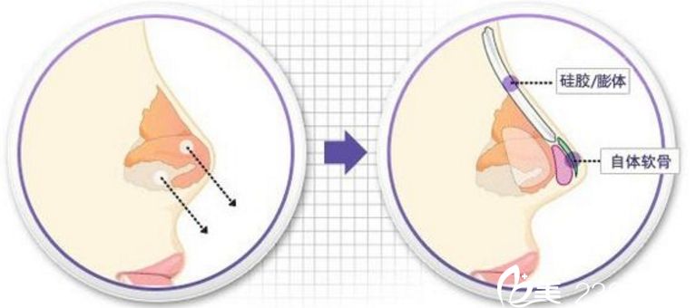 假體隆鼻 隆鼻到底是膨體好還是硅膠好 