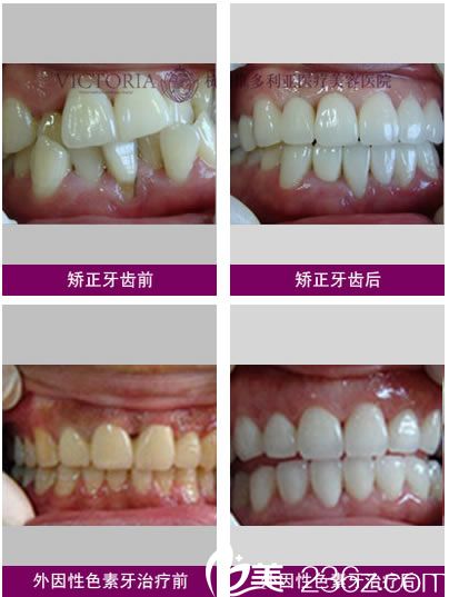 黃仁輝醫(yī)生的牙齒矯正手術(shù)案例