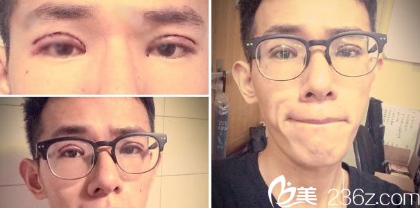 雙眼皮手術(shù)當(dāng)天的效果圖