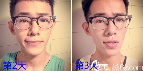 全切雙眼皮去皮脂手術(shù)第3天