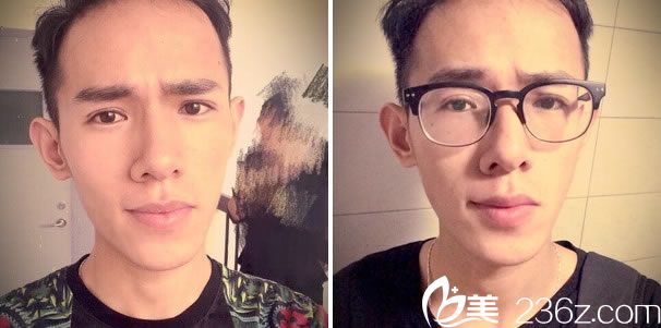 全切雙眼皮手術(shù)第10天的效果