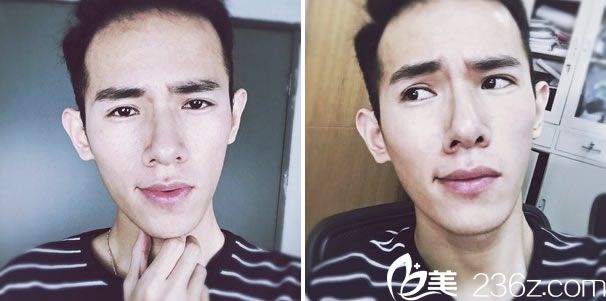 全切雙眼皮去皮脂手術(shù)50天效果