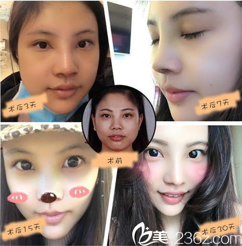 維多利亞隆鼻真人案例圖