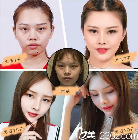 假體隆鼻手術(shù)30天的效果圖