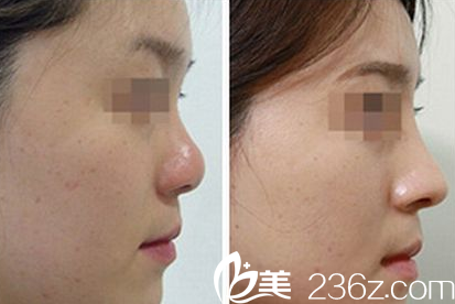 陳玉連隆鼻整形案例