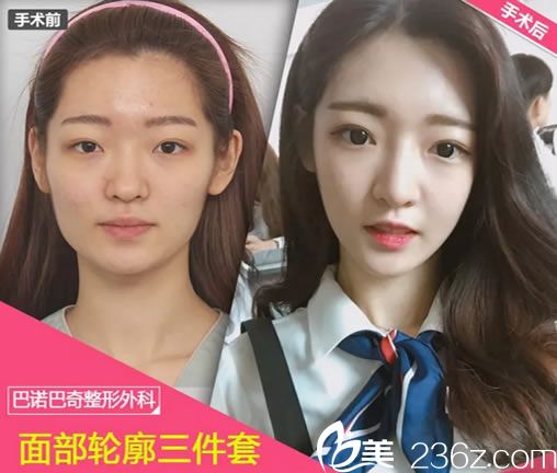 巴諾巴奇面部輪廓三件套案例