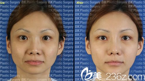 面部輪廓整形案例