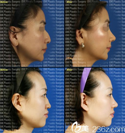 高殷錫院長的鷹鉤鼻矯正案例