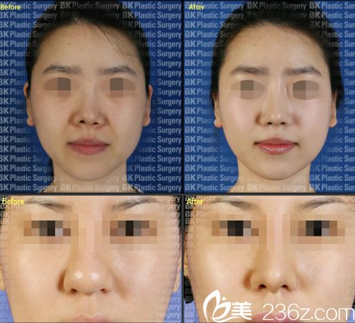 高殷錫院長鼻修復(fù)案例