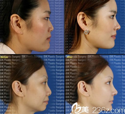 高殷錫院長隆鼻手術(shù)案例