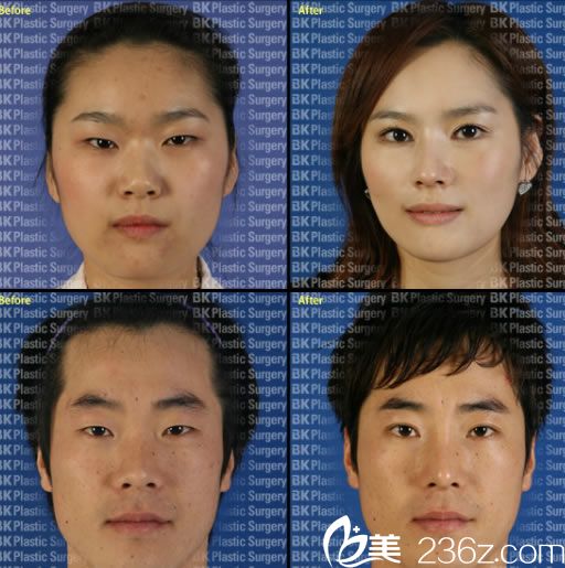 都彥祿院長的切開法雙眼皮案例