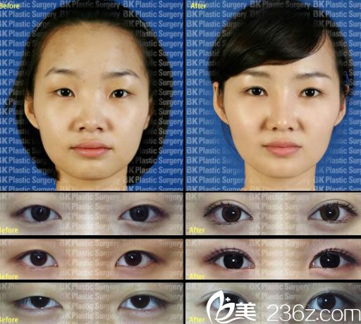 埋線法雙眼皮案例