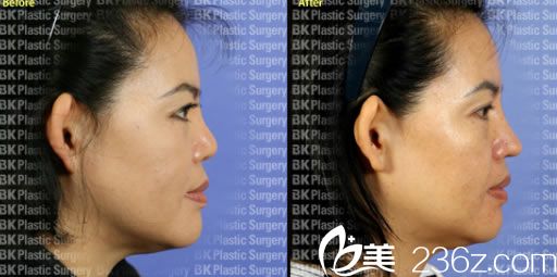 姜相求院長短鼻矯正案例