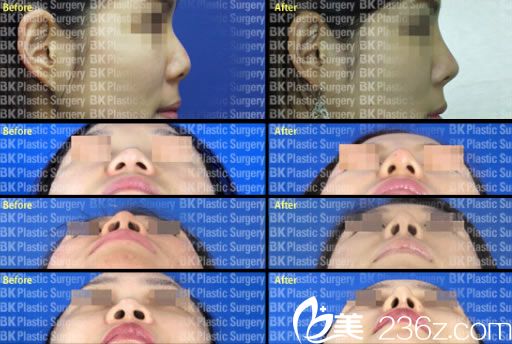 李丙濬院長(zhǎng)的鼻整形案例