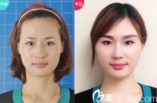 張敏自體脂肪填充案例圖 張敏自體脂肪填充案例圖